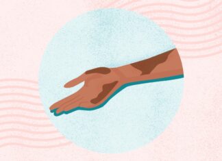 Екзема: Вивчення сверблячої правди про це поширене шкірне захворювання