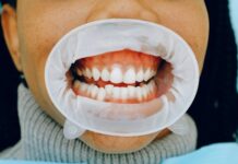 Відбілювання зубів при рецесії ясен: посібник з безпечної та ефективної процедури