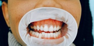 Teeth Whitening with Gum Recession: A Guide to Safe and Effective Treatment