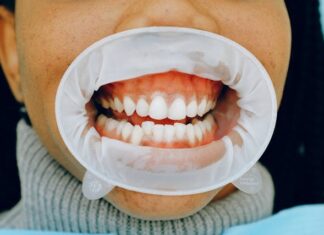 Відбілювання зубів при рецесії ясен: посібник з безпечної та ефективної процедури