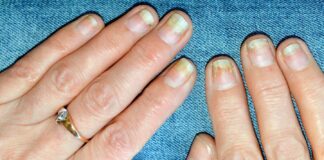 Psoriasis-Arthritis und Nagelschäden: Was Sie wissen müssen