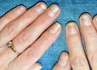 Псоріартрит і пошкодження нігтів: що вам потрібно знати