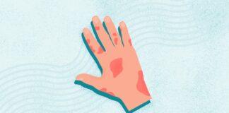 Псориатический Артрит: Понимание Симптомов, Типов и Лечения