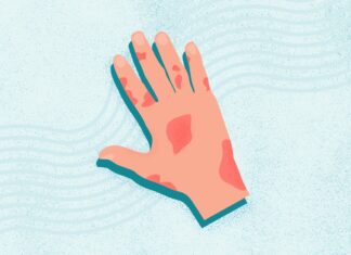 Псоріатичний Артрит: Розуміння Симптомів, Типів та Лікування