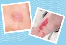 Понимание лейкоза и его влияния на кожу: симптомы, сыпь и признаки