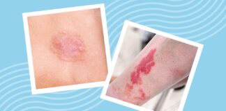 Понимание лейкоза и его влияния на кожу: симптомы, сыпь и признаки